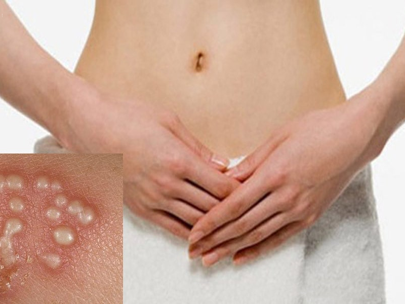 Biểu hiện bị nhiễm Herpes sau khi quan hệ tình dục Biểu hiện bị nhiễm Herpes sau khi quan hệ tình dục