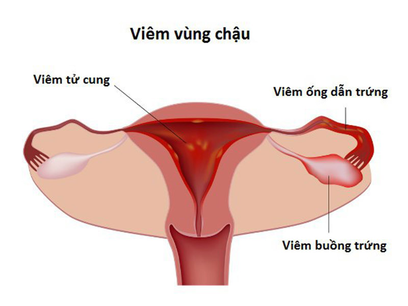 Do âm đạo bị co thắt Do âm đạo bị co thắt