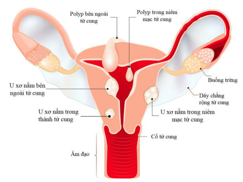 Do chịu ảnh hưởng bởi các khối u ở phần phụ Do chịu ảnh hưởng bởi các khối u ở phần phụ