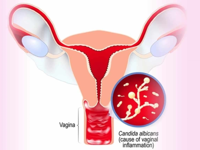 Do nhiễm trùng âm đạo Do nhiễm trùng âm đạo