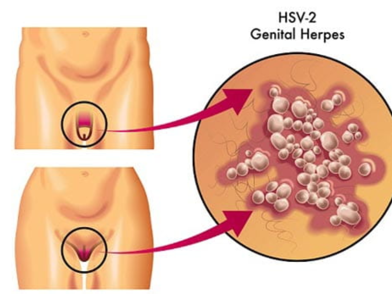 Herpes là bệnh gì? Herpes là bệnh gì?