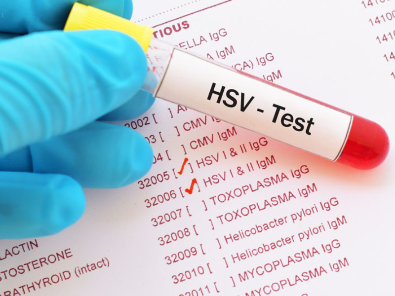 Nên làm gì khi có dấu hiệu nhiễm Herpes Nên làm gì khi có dấu hiệu nhiễm Herpes