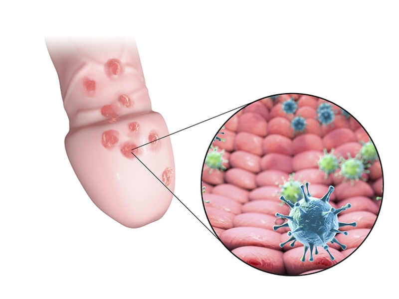 Tại sao lại nhiễm Herpes khi quan hệ tình dục Tại sao lại nhiễm Herpes khi quan hệ tình dục